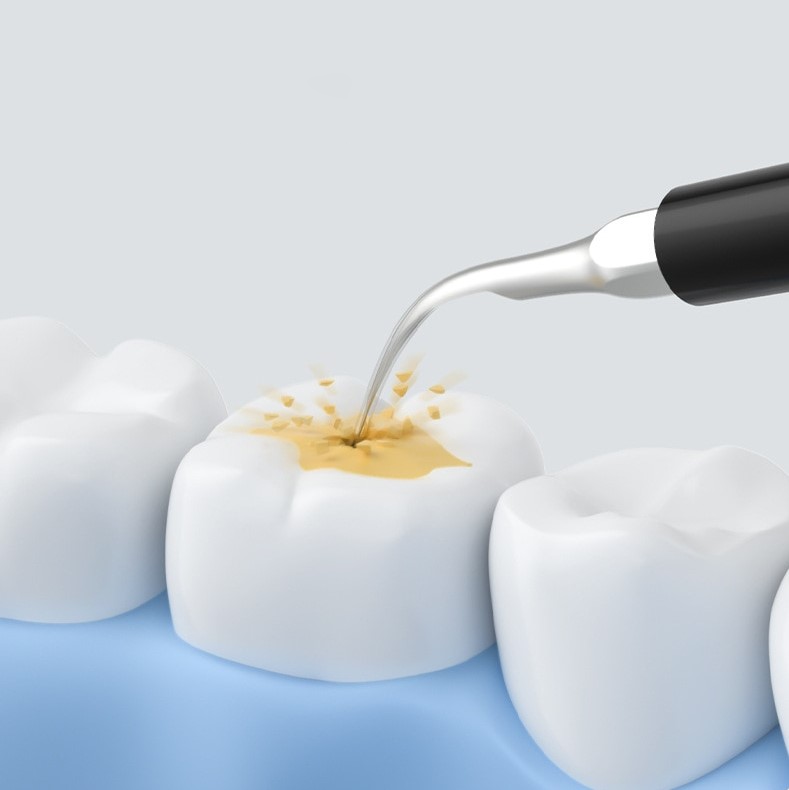 Ultraschall-Zahnreinigungsset™
